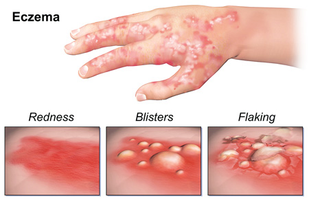 Eczema