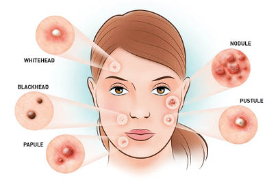 Heal Acne With Homeopathy