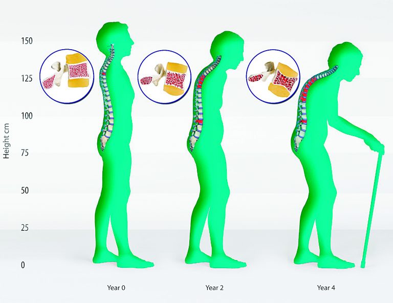 Making No Bones – Osteoporosis