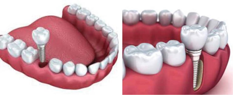 Dental Implants: Luxury Or Necessity?