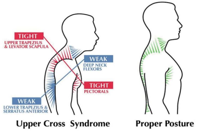 Upper Crossed Syndrome