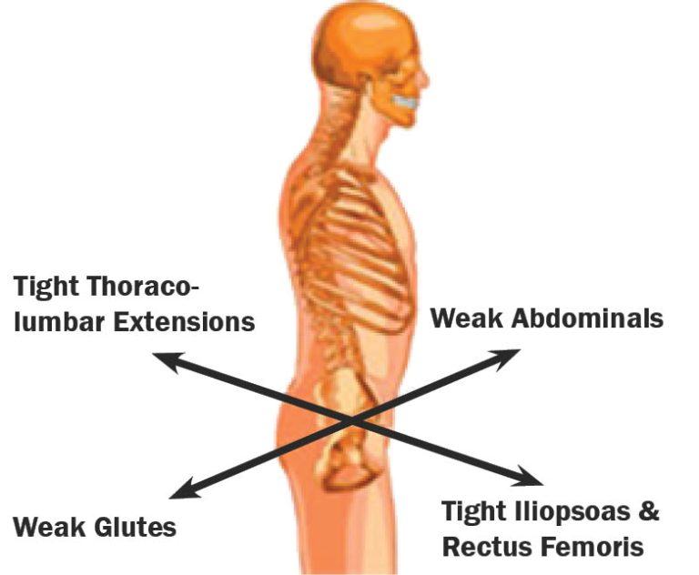 Lower Cross Syndrome