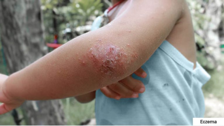 How To Treat Your Skin Allergy