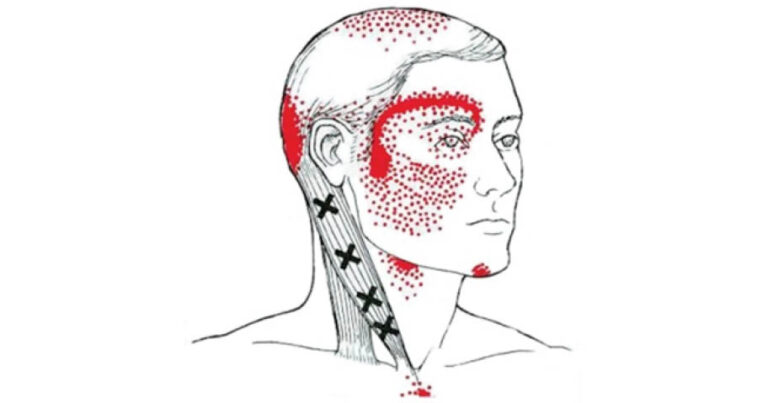 Headache – A Pain In The Neck!