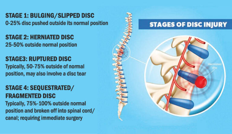 Spinal Decompression therapy